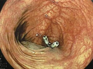 大腸内視鏡検査 202004